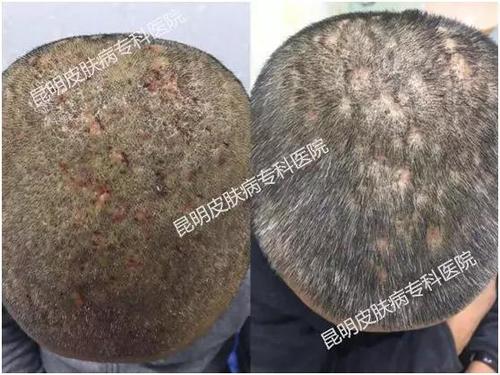 痤疮和毛囊炎完全不是一种病,正确区别,不可一概而论!