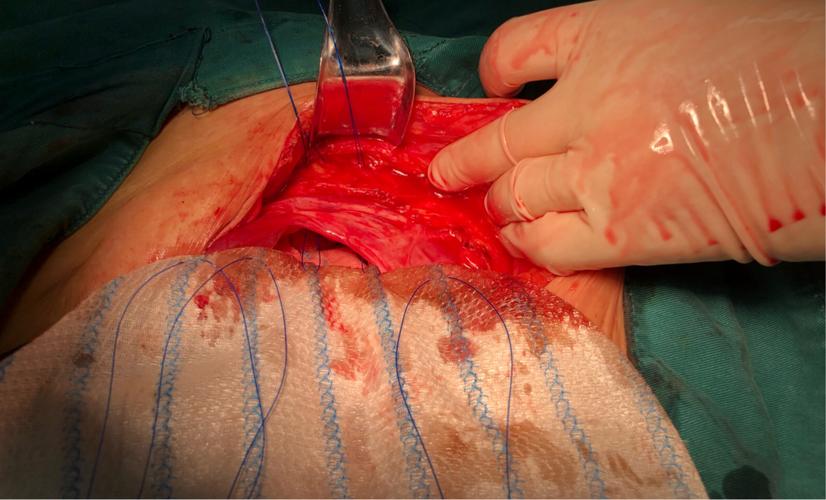 下腹壁切口疝无张力修补