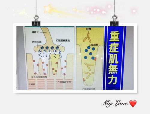 这幅图完美阐释了重症肌无力发病机制.