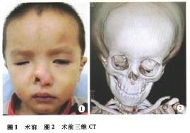 呈前后两层剥离皮肤及鼻黏膜后,发现右侧鼻翼软骨及鼻骨部分缺失,遂将
