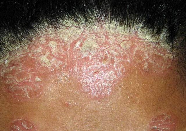 如何区分头皮屑和头皮牛皮癣银屑病真实对照图解