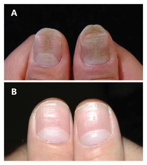 今日病例:这种甲营养不良叫什么?