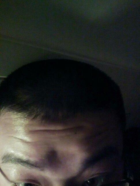 一抬眉毛印堂处有个坑咋回事