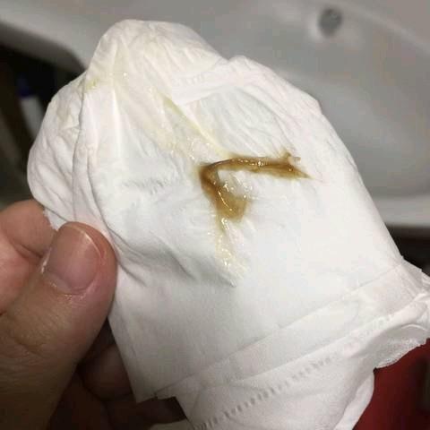 今天下午排出白色透明宫颈黏液     下午又发现图片那种颜色     是不