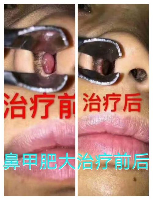 鼻甲肥大治疗前与治疗后对比