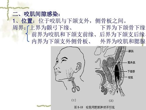 颌面部间隙感染新解ppt