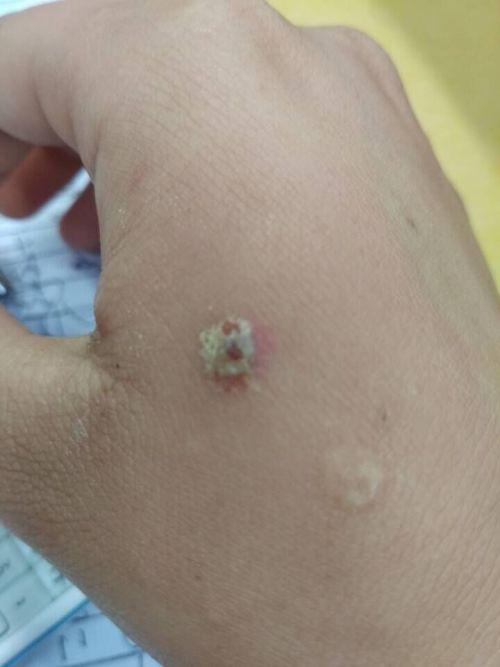 手上长的这个是不是干疮?