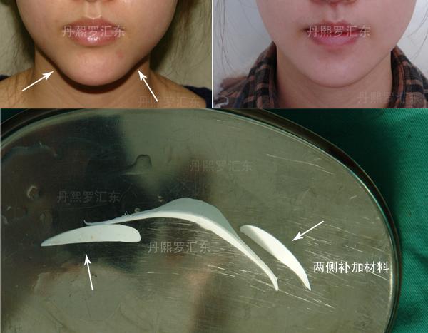 北京膨体隆下巴补片理念衔接自然魏洁院长领衔团队亲诊垫下巴改善颏短