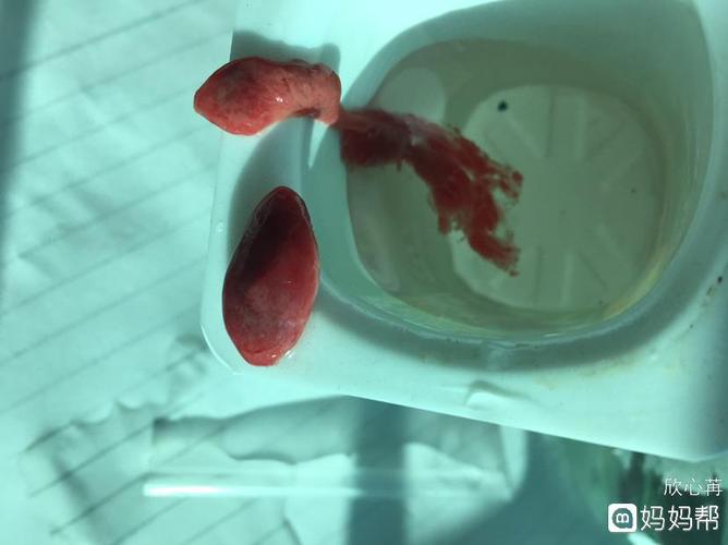 正能量超大子宫内膜息肉25cm正式保守治疗一个月顺利排掉