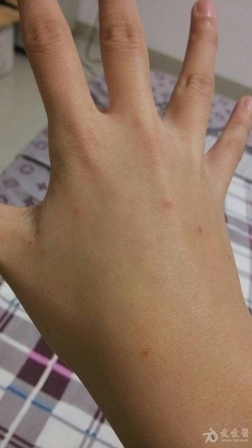 手疥疮样皮疹求教