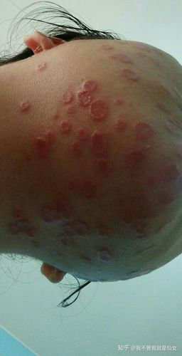 真菌感染,面部体癣,猫咪