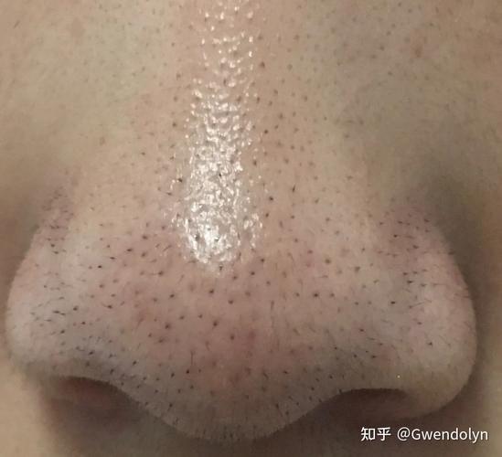鼻子上长了黑头里面还有黑色的毛这是什么类型的黑头怎么去除
