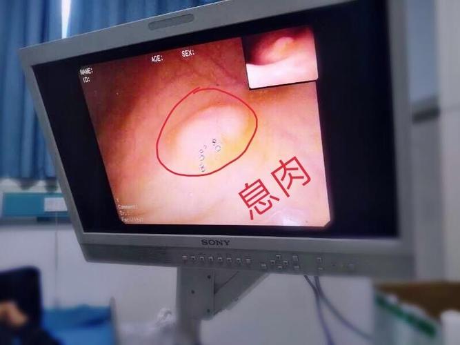 清晰可见的肠道息肉