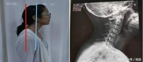 颈椎反弓是什么鬼?这病可不少见,大幂幂和霉霉都是高危患者