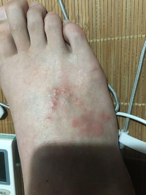 脚上长了好多小水泡