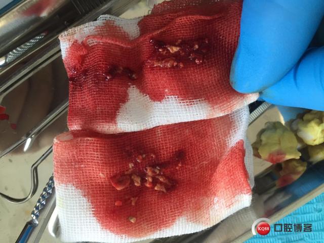 一例前牙根尖脓肿