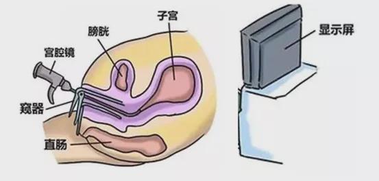 良医汇肿瘤资讯 简单来说,宫腔镜的镜头是一根细长的金属管,通过宫颈