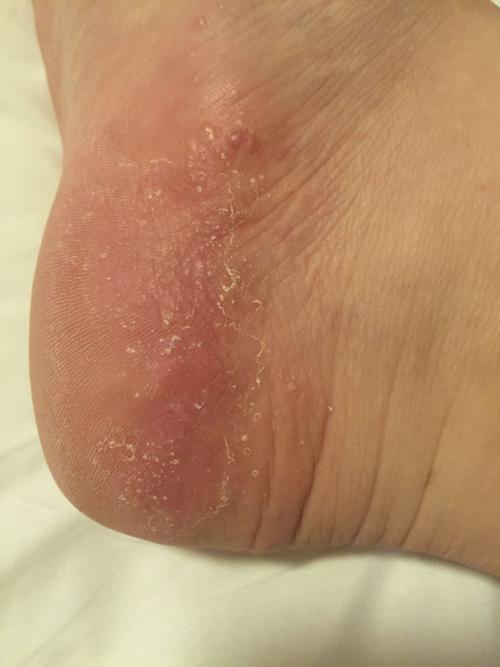 脚上湿疹图片