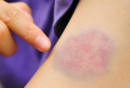 如果不幸得了白血病后皮肤上会有这个信号,你注意到了