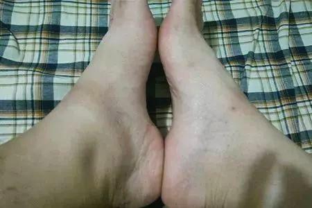 为什么痛风多复发?清晨一旦有这四现象,说明痛风潜伏于身