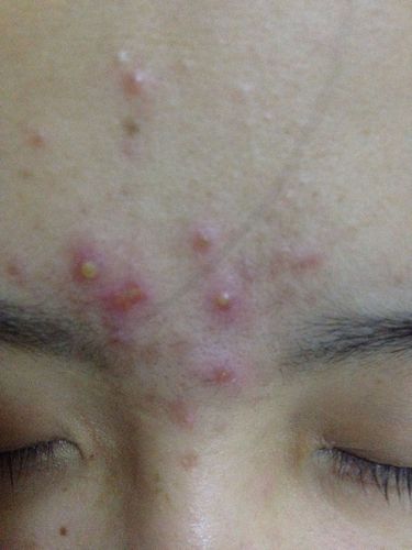 眉心起痘 有点疼
