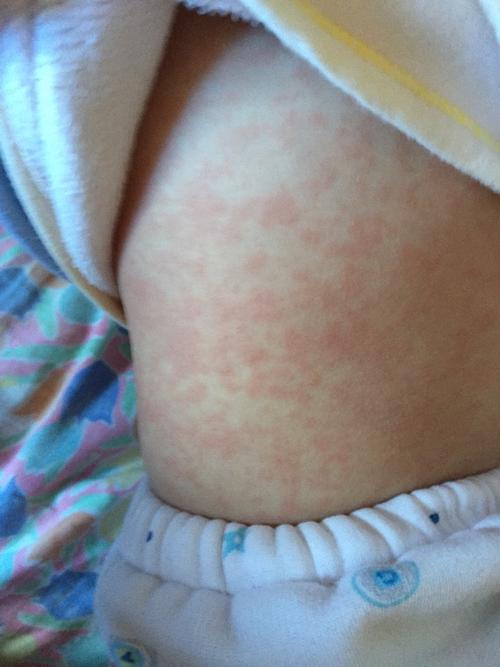 孩子发烧几天了,现在烧退了,脸上身上起的都是红点,哪