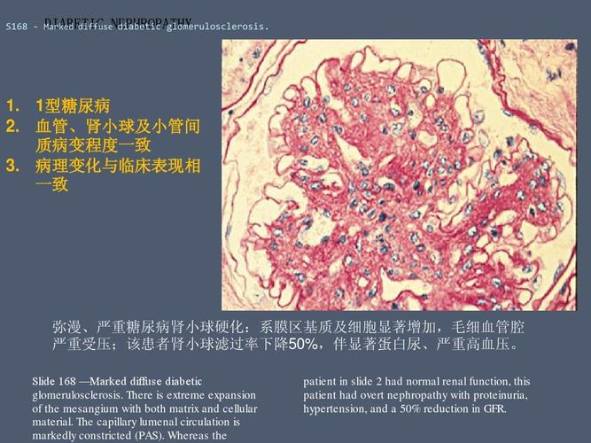 5糖尿病肾病的病理abc(定)ppt