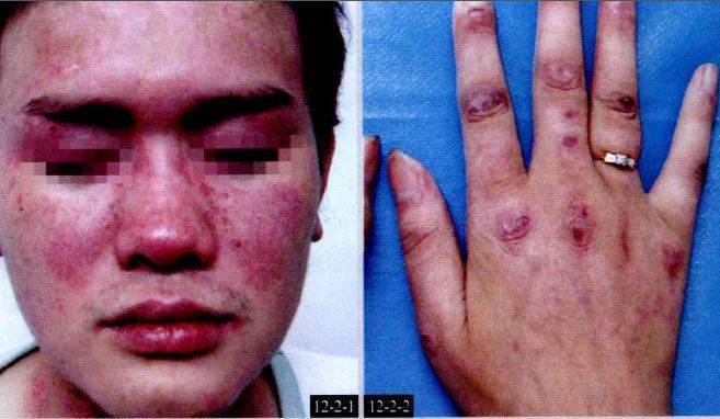 64变应性皮肤血管炎65结节性血管炎66荨麻疹性血管炎67鱼鳞病68毛发角