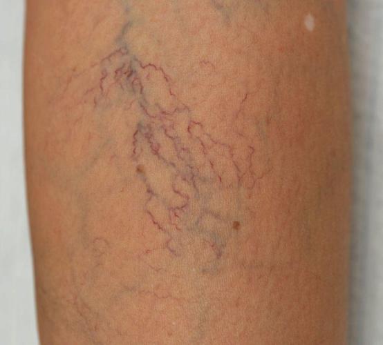 我们每一期都会有图片示意: 第一期:毛细血管扩张,此期人数最庞大