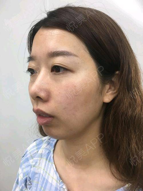 之前打玻尿酸的时候就一直关注这家医院,觉得不管.