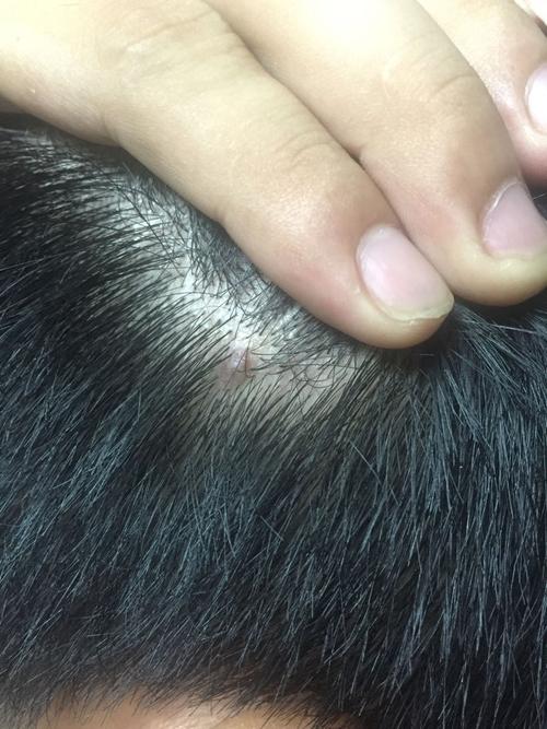 头皮上长了一课小疙瘩