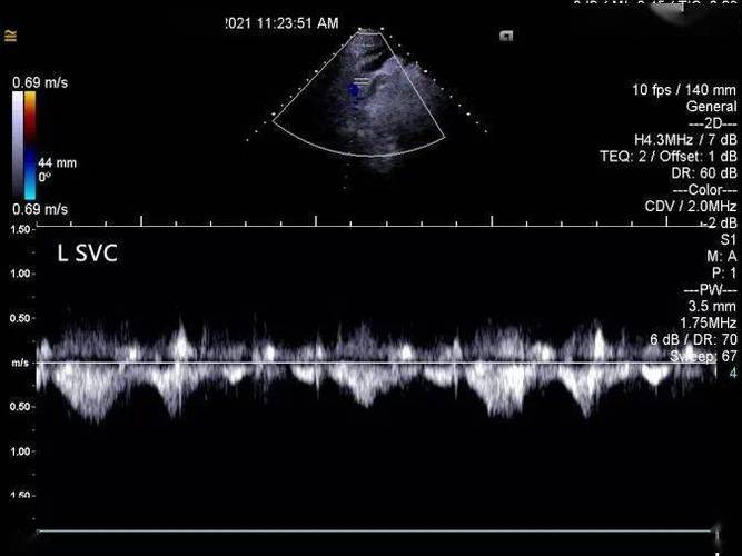 图 4 彩色多普勒超声示左位上腔静脉呈蓝色血流信号图 3 胸骨上窝切面