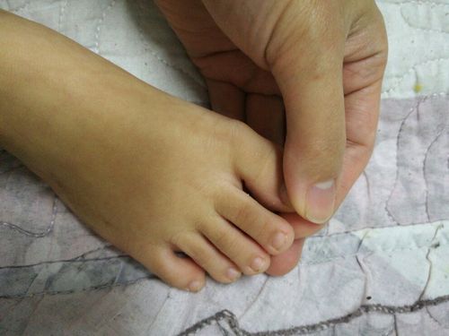 三周岁男宝大脚趾关节处有个包.医生说是腱鞘囊肿,需要手术吗?