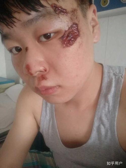 对于自己左脸上的疤痕很自卑?