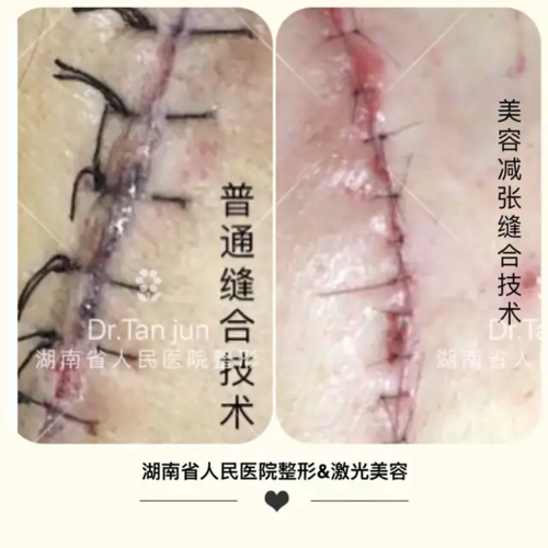 美容减张缝合技术与点阵激光技术的关系
