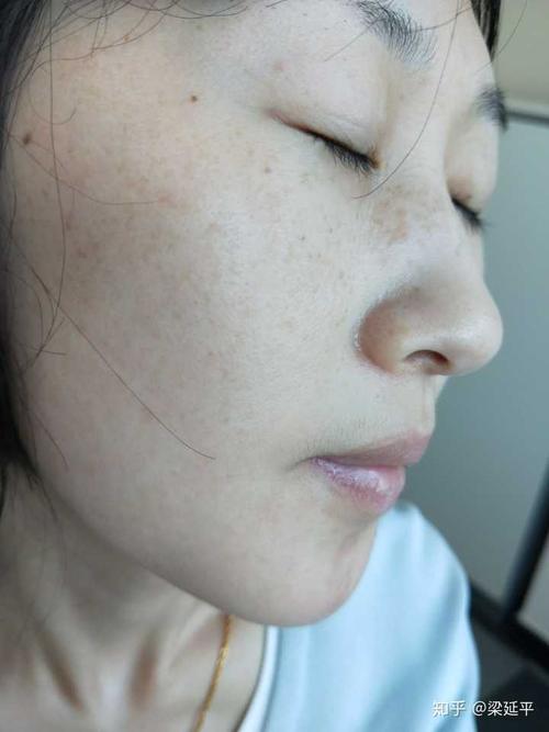 你们觉得长雀斑的女孩子,很丑吗?