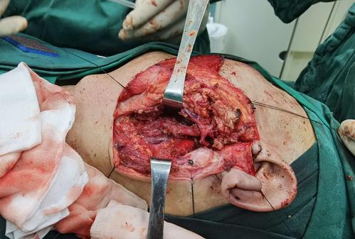 北京友谊医院通州院区耳鼻咽喉头颈外科完成罕见的咽旁间隙鳃裂囊肿