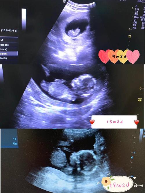 孕期过一半了,宝宝在妈妈肚子里已经20周