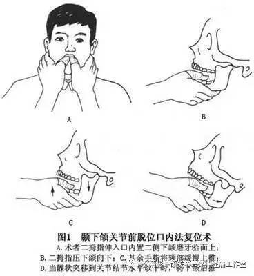 "笑掉下巴"---颞下颌关节脱位的治疗浅析