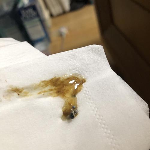 【求助】(慎入)这是肠粘膜吗?