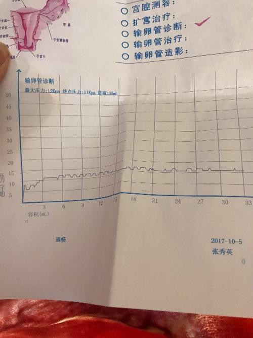 输卵管通水最大压力12kpa 最终压力11kpa 阻力大吗