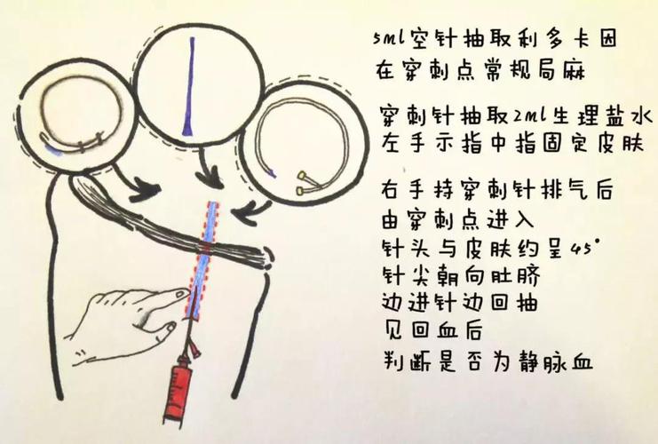 股静脉穿刺置管要点总结