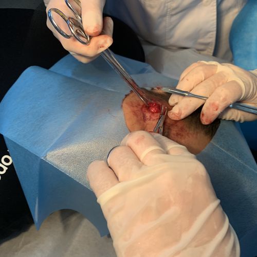 面部肿物切除术