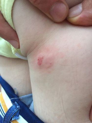 刚刚小孩给泰迪狗揪住,后来就有了这个伤口,不知道是不是泰迪狗咬的