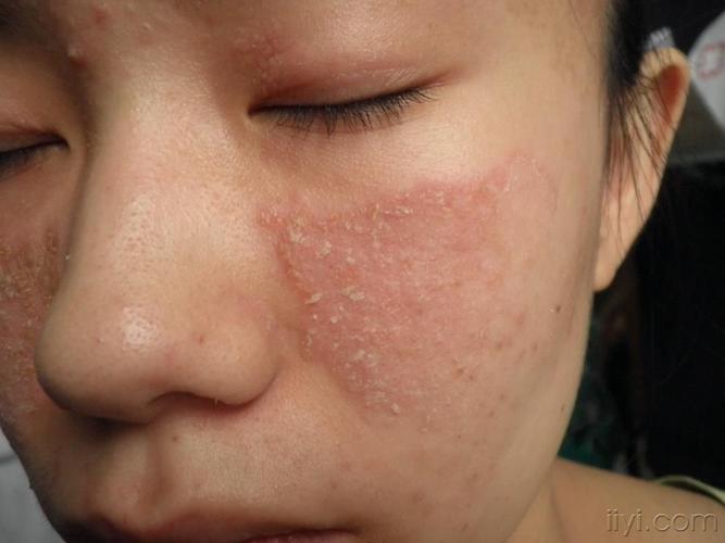 脂溢性皮炎能吃鳗鱼吗