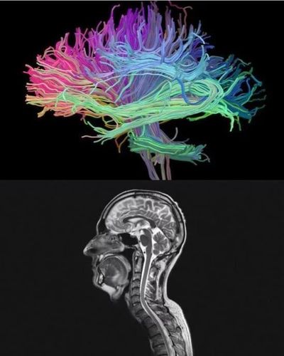 弥散张量成像(dti),主要应用在检测脑白质的发育,成熟及生理性老化