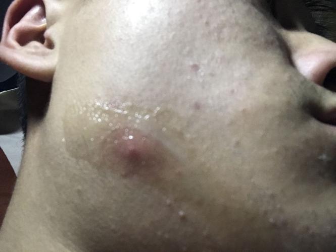 脸颊和脖子长了个很硬的痘痘