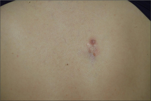 隆突性皮肤纤维肉瘤通常发生在成年早期,通常是一个增长缓慢,但持续