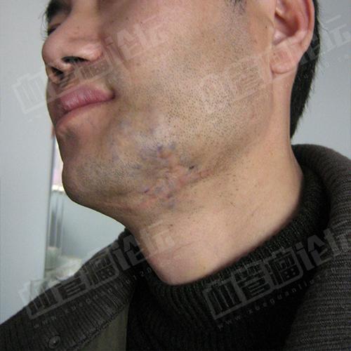 雷*会(成人)-面部-静脉畸形(海绵状血管瘤)