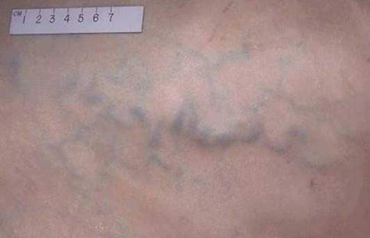 腹壁静脉曲张平面图周围血管疾病病人的护理一,下肢静脉曲张下肢静脉